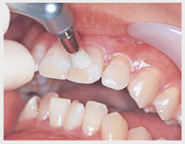 歯のマニキュアを塗るため前歯の表面を清掃します