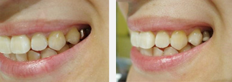 銀歯のコーティング症例