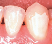下の歯のコーティング症例