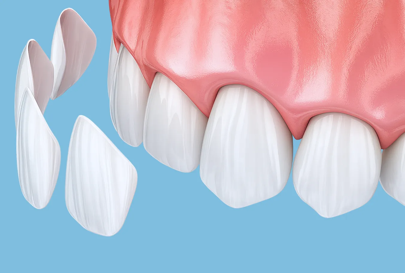 ラミネートベニア