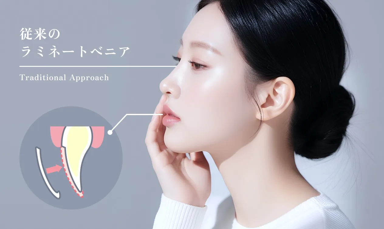 従来のラミネートベニア